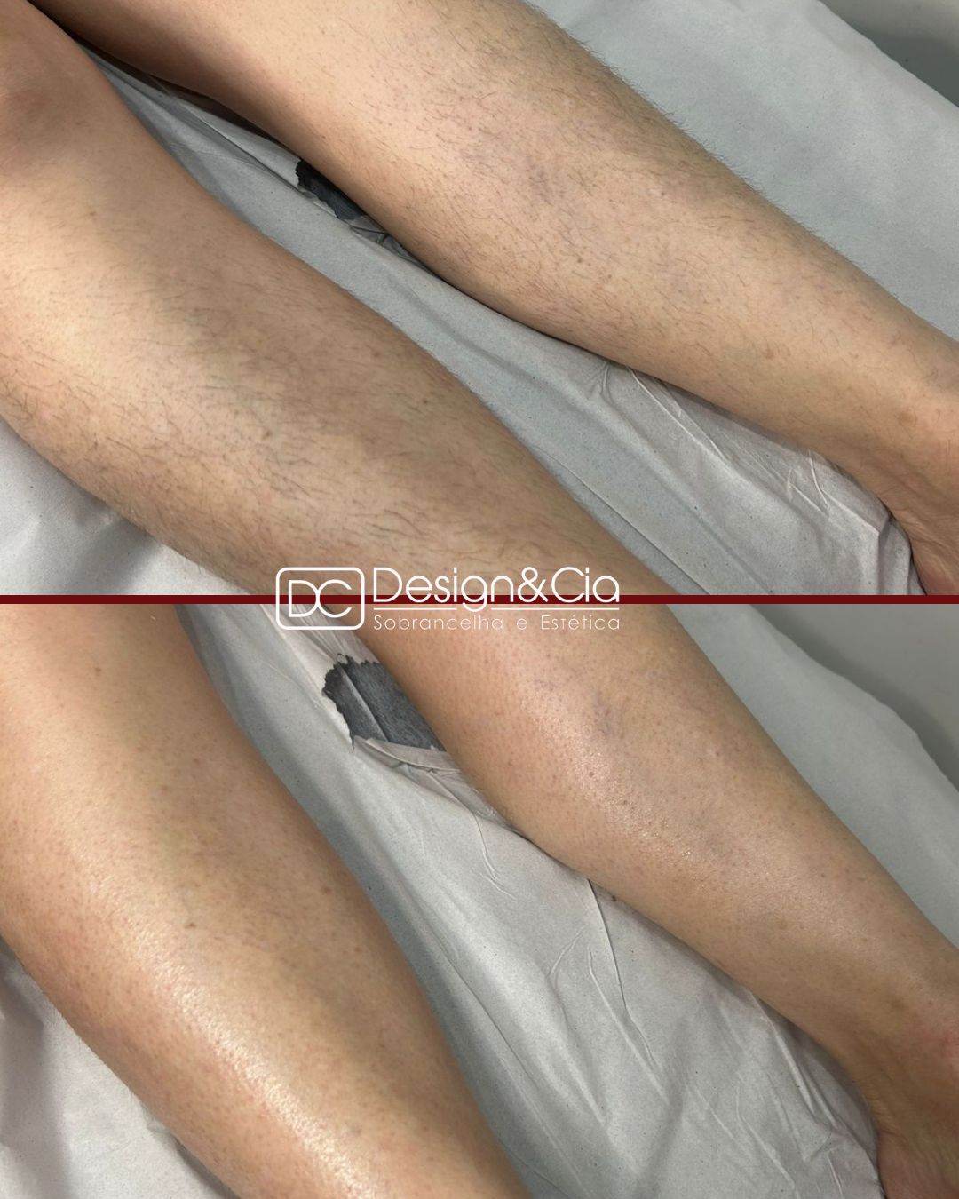 Depilação de pernas – antes e depois