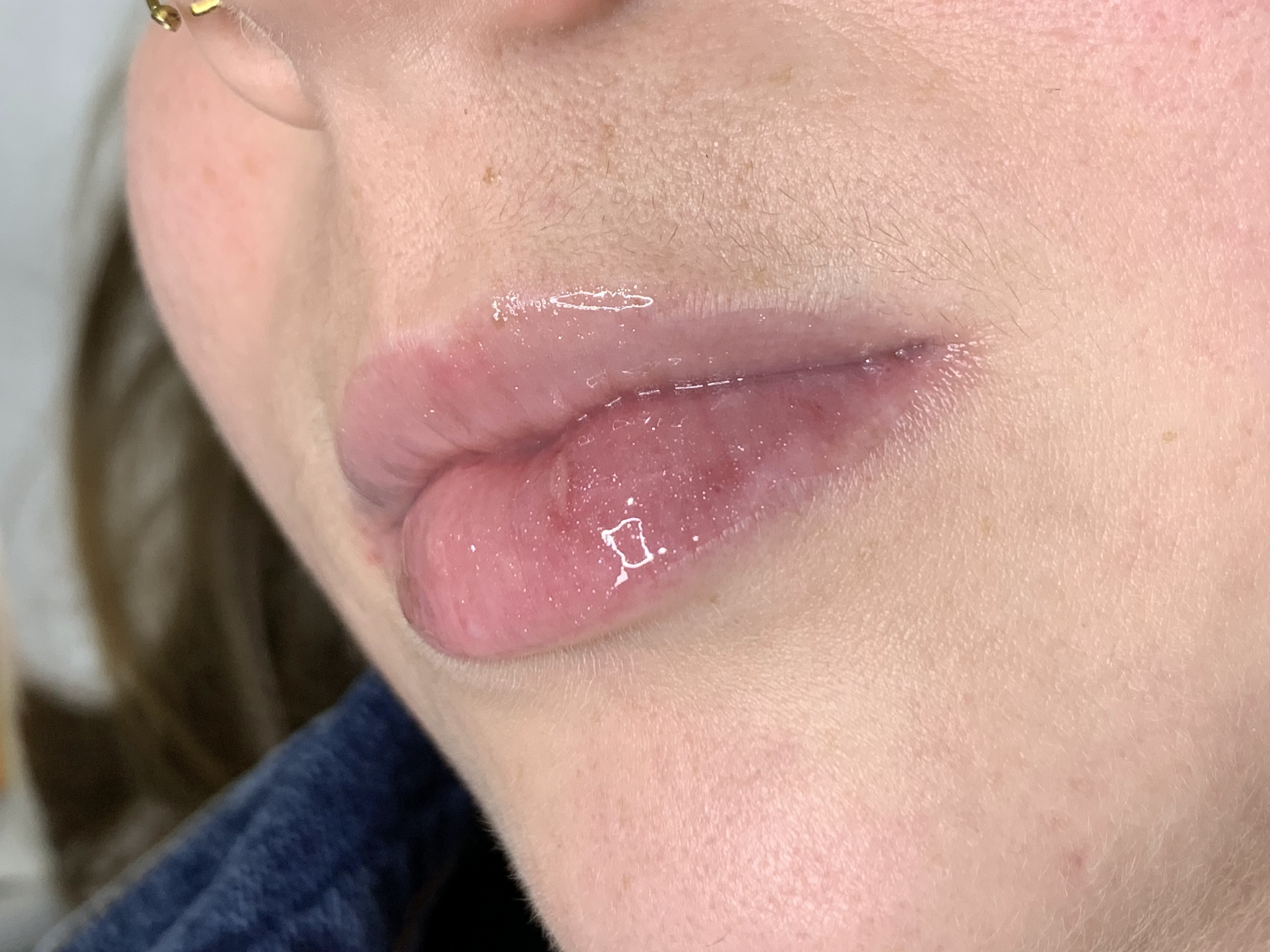 Resultado de hidragloss labial